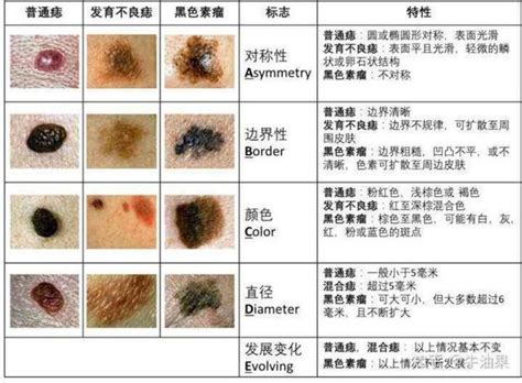 身體長痣的原因|痣是什麼？會變成黑色素瘤？7種一定要除的痣